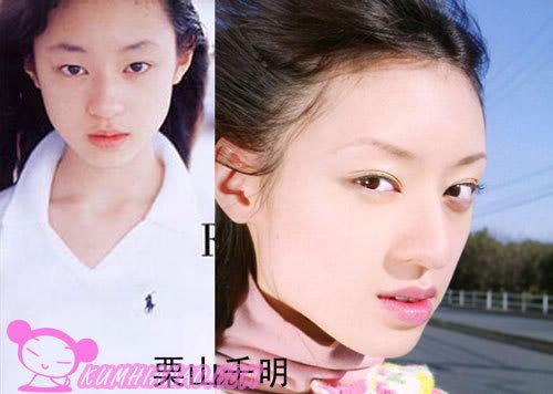 Japanese celebrity pictures cosmetic surgery